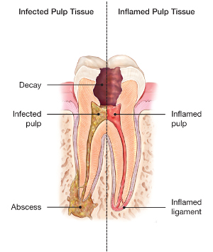 abscessed-tooth.jpg