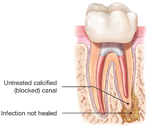 endodontic-retreatment-tooth-abscess.jpg