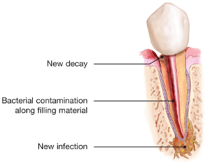 endodontic-retreatment-tooth-infection.jpg