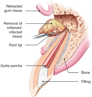 endodontic-surgery.jpg