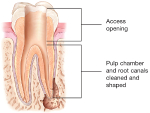 Root-Canal-Access-Opening.jpg