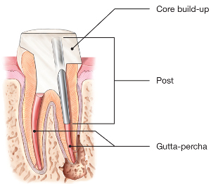 Root-Canal-Post.jpg